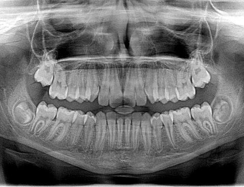 bracitos metálicos