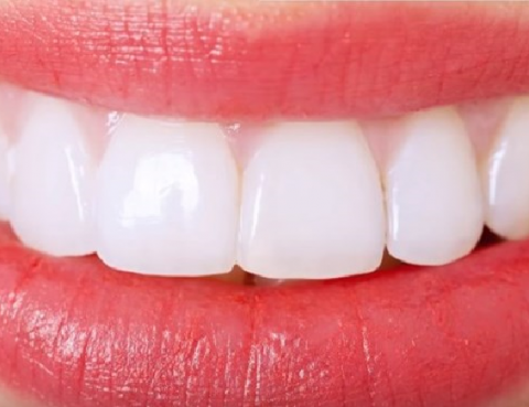 blanqueamiento dental