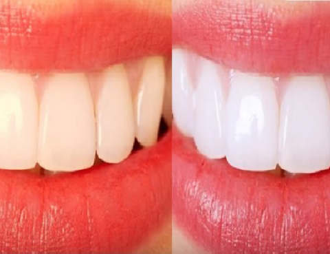 tener los dientes blancos