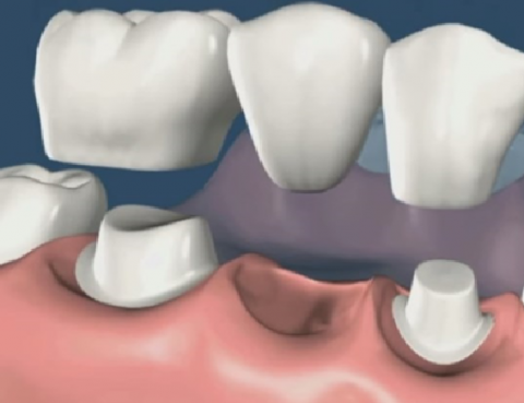 puente dental