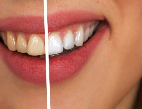 técnicas de blanqueamiento dental