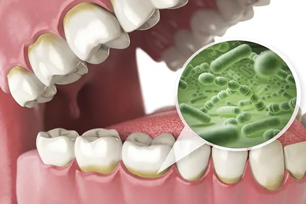 Manchas marrones en los dientes