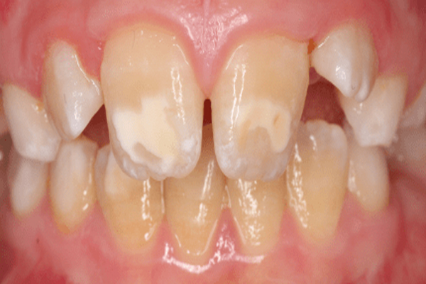 Manchas marrones en los dientes