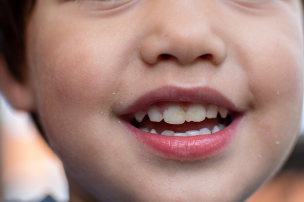 Manchas marrones en los dientes