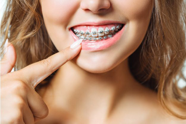 Manchas marrones en los dientes