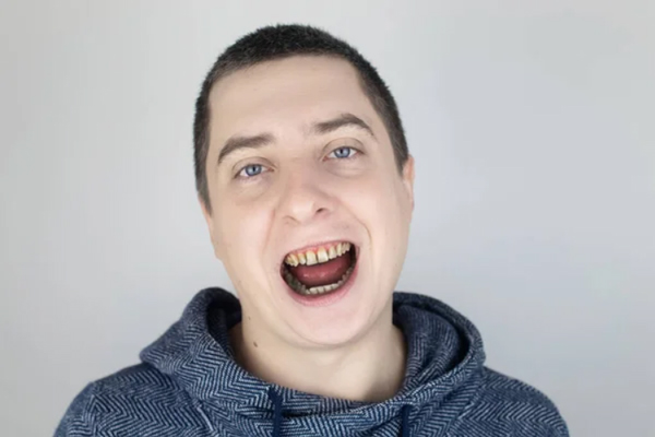 Manchas marrones en los dientes