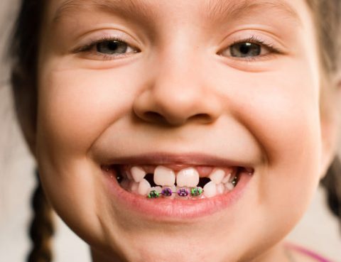 Agenesia dental
