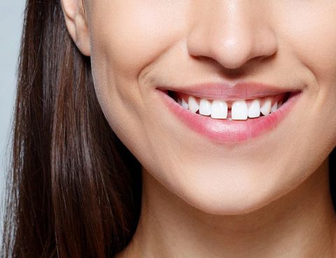 Diastema dental