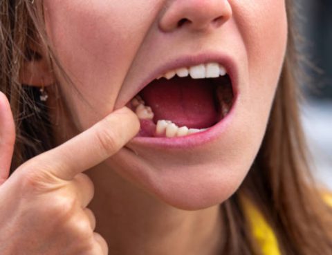 Dientes perdidos: ¿Qué ocurre al no reemplazarlos?