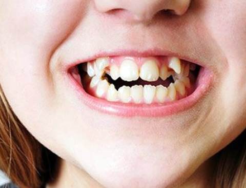 Supernumerario dental