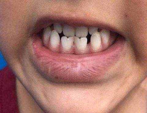 Geminación dental