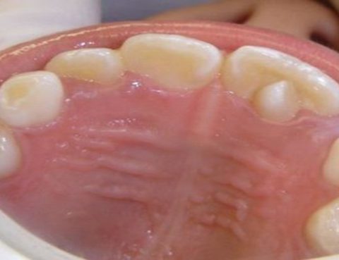 Talón cuspídeo dental