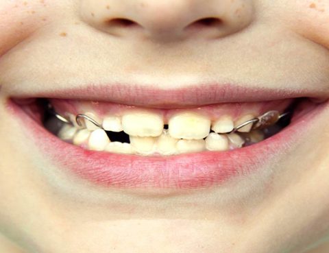 Anquilosis dental