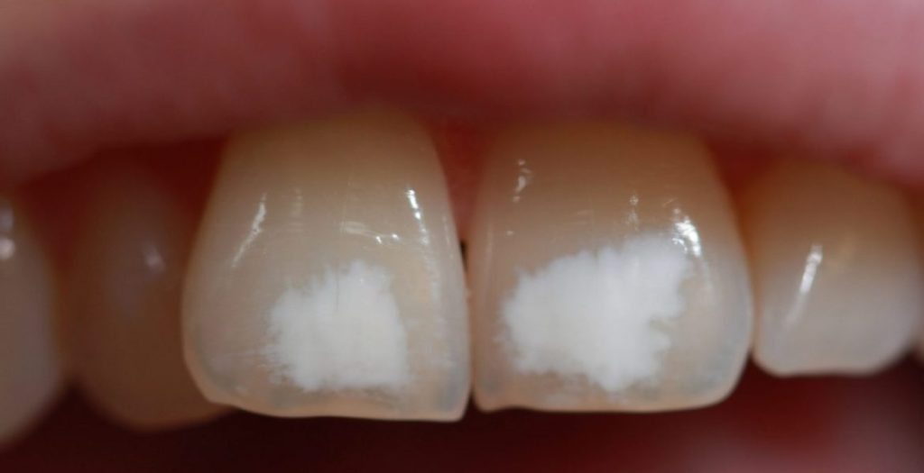 tipos de manchas en los dientes
